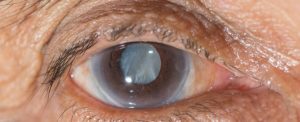 The Prevention of Cataract